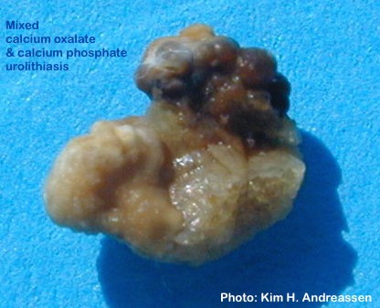 Nyresten (calciumoxalat + calciumfosfat)