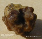 023-kidney-stone-nyresten-CaOxPh-Kim-Hovgaard-Andreassen