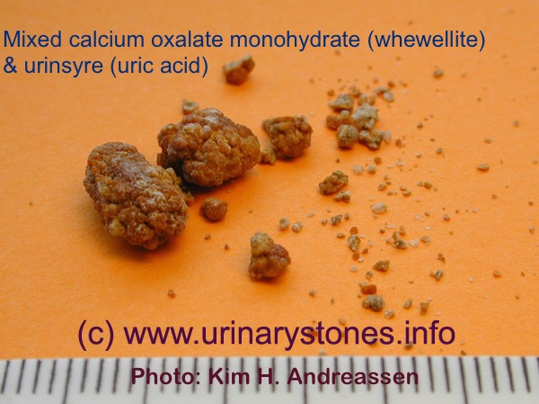 Nyresten (urinsyre og calciumoxalat) spontan passage