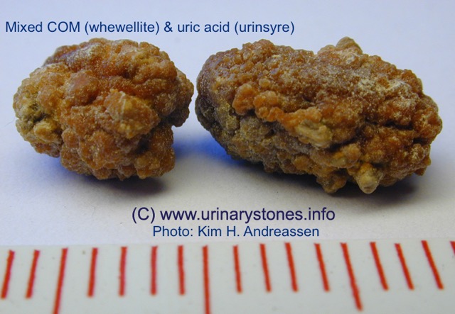 Nyresten (urinsyre og calciumoxalat) spontan passage