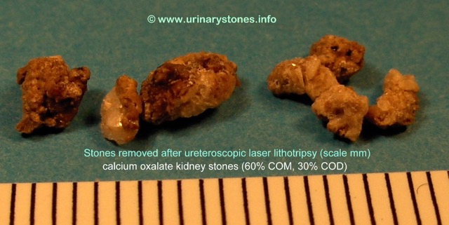 Nyresten (calciumoxalat) fra URSL