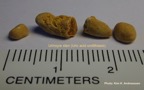 057a-kidney-stone-nyresten-UricAcid-urinsyre-spontan-Kim-Hovgaard-Andreassen