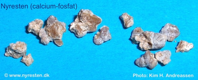 Nyresten (calciumfosfat) fra URSL