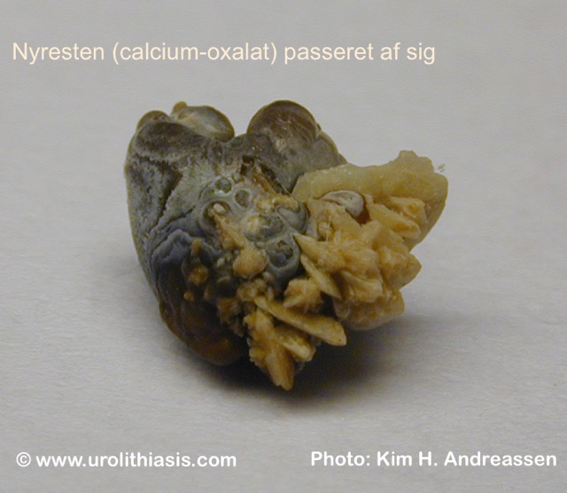 Kidney stone (calcium oxalate)