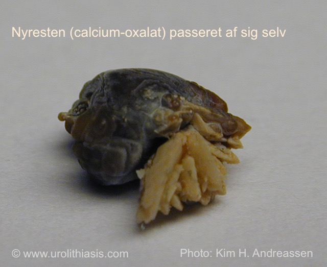 Nyresten (calcium oxalate)